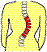 scoliose :scoliose